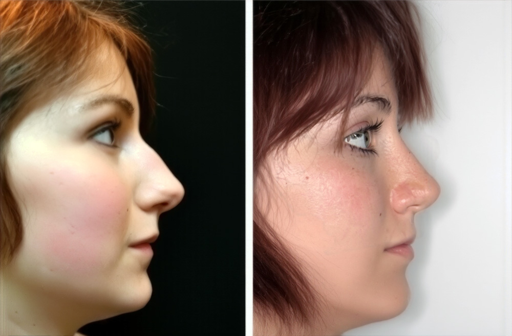 Ragazza prima e dopo operazione al naso