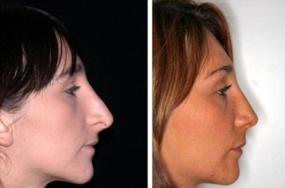 Donna prima e dopo operazione al naso